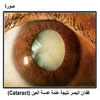 ����� ����� ����� ���� ���� ����� (Cataract)